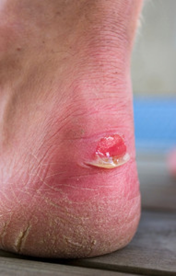 Can Blisters on the Feet Become Infected